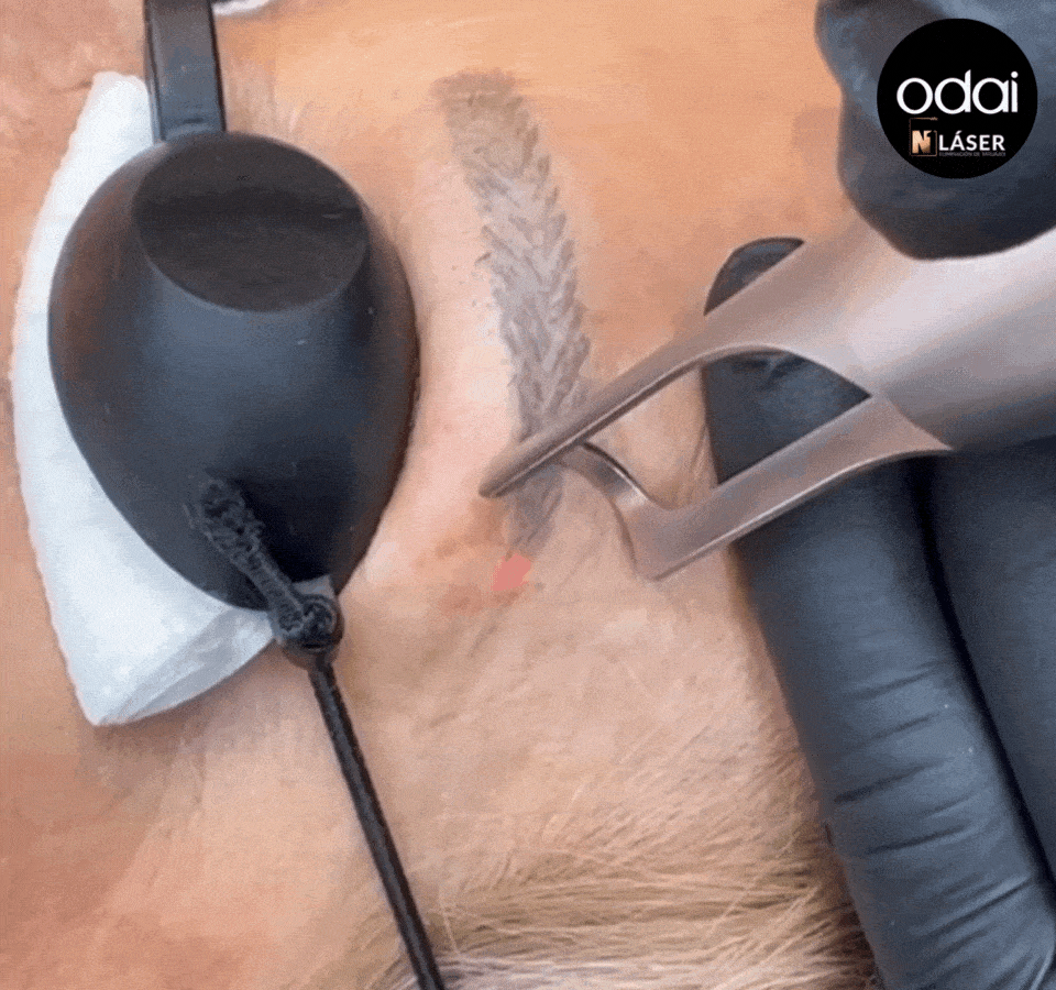 ELIMINACIÓN MICROPIGMENTACIÓN