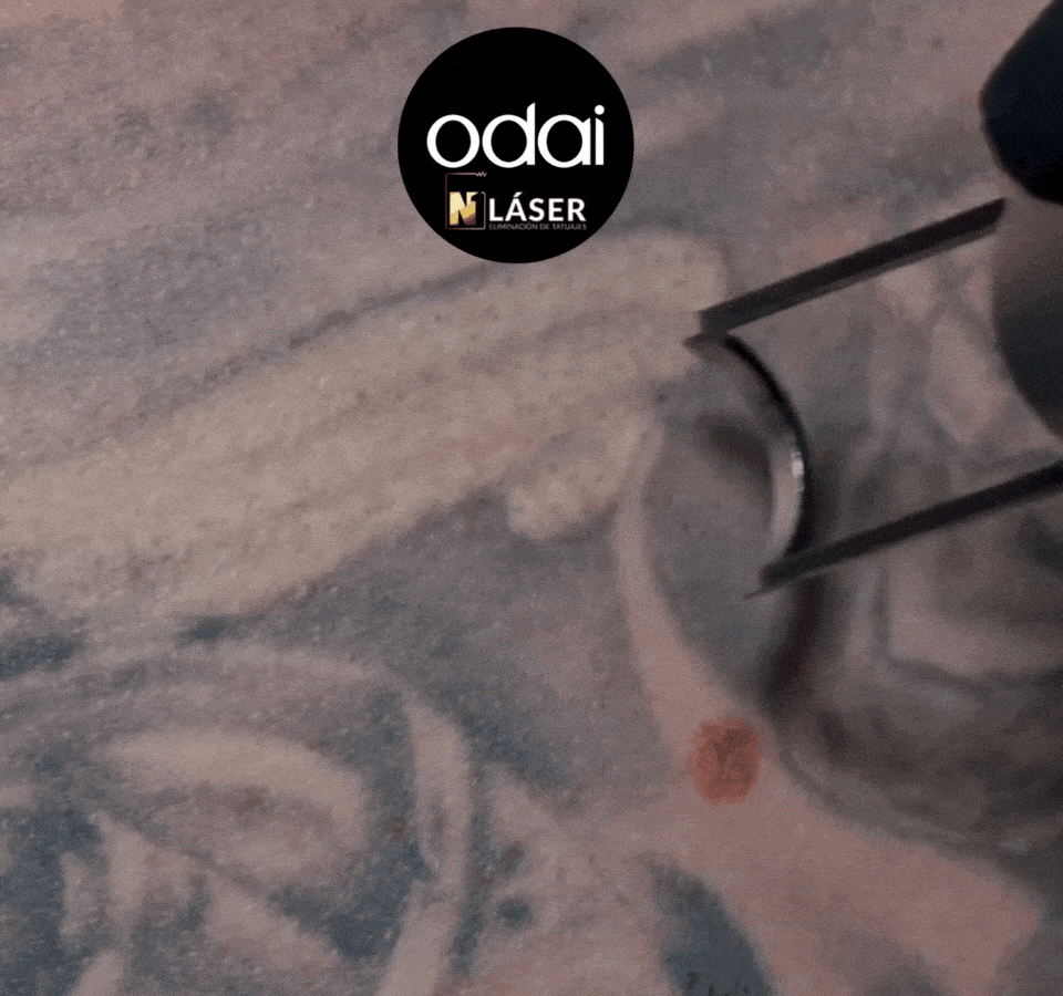 ELIMINACIÓN DE TATUAJES