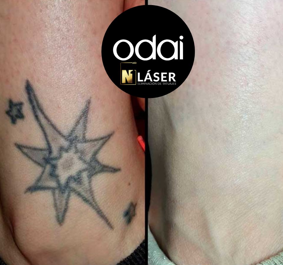 ELIMINACIÓN DE TATUAJES